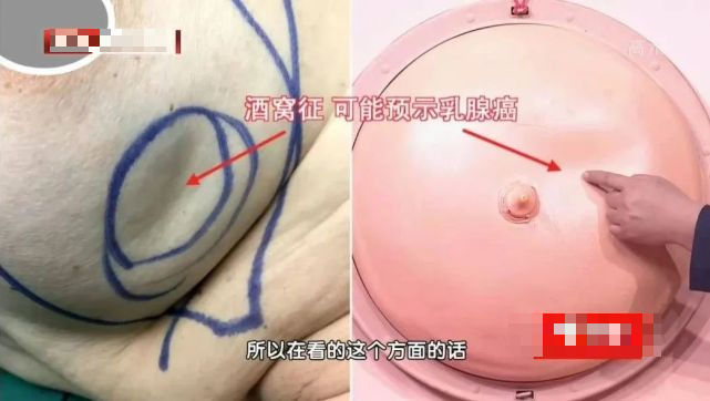 乳头真实照片真人图片